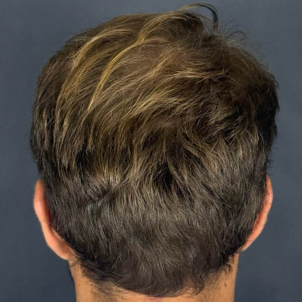 After: Men's hair restoration - Patient 1