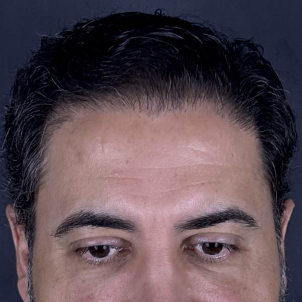 After: Men's crown restoration - Patient 5