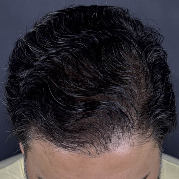 After: Men's crown restoration - Patient 6