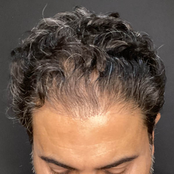 Before: Men's crown restoration - Patient 5