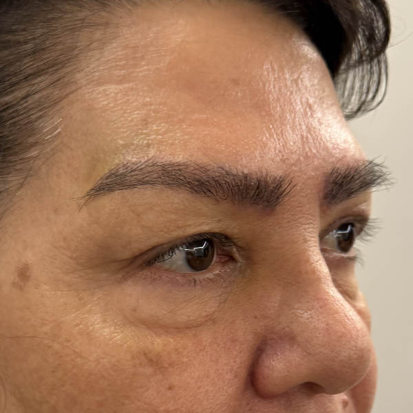 After: Eyebrow restoration - Patient 2