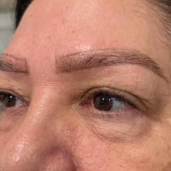 Before: Eyebrow restoration - Patient 1