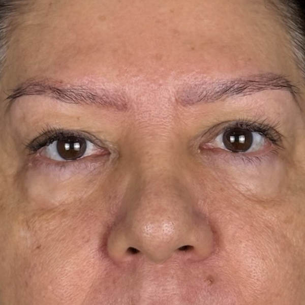 Before: Eyebrow restoration - Patient 2
