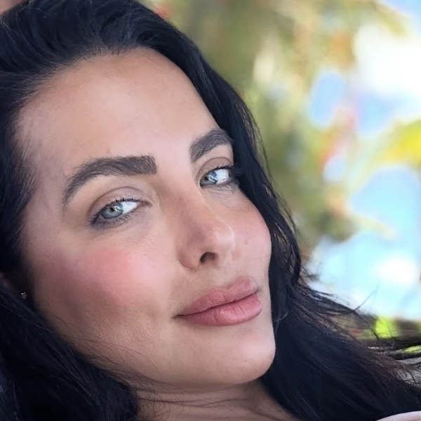 After: Eyebrow and hairline restoration - Patient 2