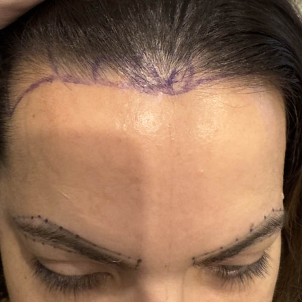 Before: Eyebrow and hairline restoration - Patient 1