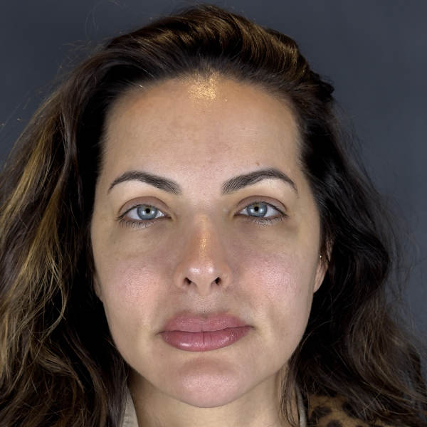 Before: Eyebrow and hairline restoration - Patient 2