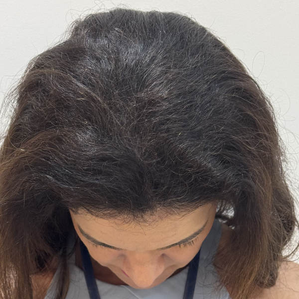 After: Women's hair restoration - Patient 1