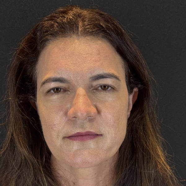 Before: Women's hair restoration - Patient 2